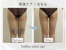 アピ(api)/症例写真【インディバ】