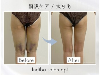 アピ(api)/症例写真【インディバ】