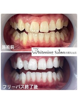 ホワイトニングサロン 京都烏丸店/ホワイトニング施術例