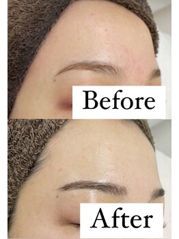 カルディエ(Cardie)/肌質改善　ビフォーアフター