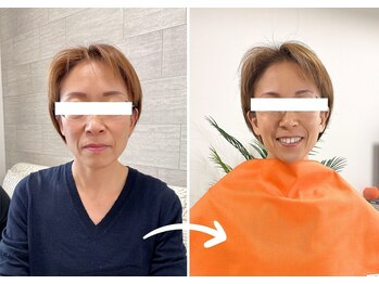 エピファニー 東京 銀座/ビフォーアフター50代(M様)