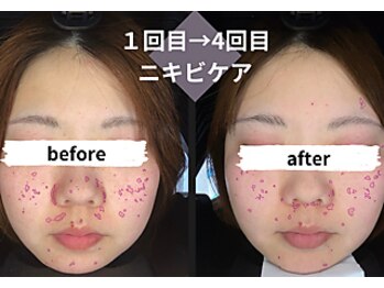 サロンスペース/30代女性　肌分析《ニキビケア》