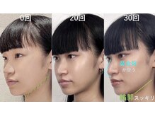 ラプリアンジュ 鹿児島天文館店(Raplit ange)/隆鼻＋輪郭矯正40分30回