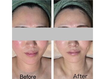 ミイン(MIIN)/ララピール&水玉リフティング