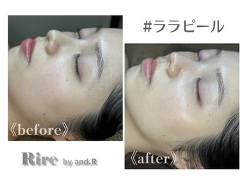 リル バイ アンドアール(Rire by and.R)/ララピール（施術1回）
