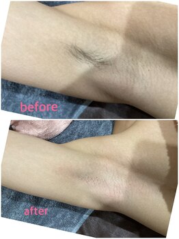 アンベリィ(Embellir)/ワキ wax脱毛