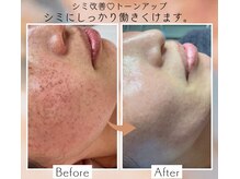 光フェイシャルでシミは取れる時代へ！