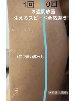 ウルル(Ululu)/【メンズ脱毛】脚脱毛1回目効果