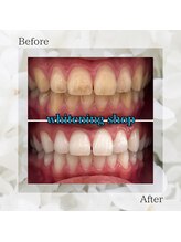 ホワイトニングショップ 太田店/ホワイトニングビフォーアフター