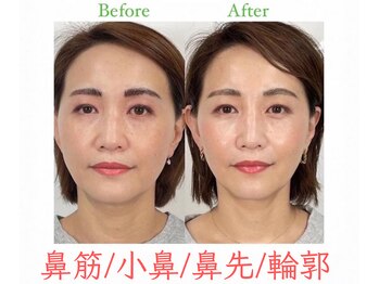 ラプリ 福岡天神店(Raplit)/隆鼻+輪郭・小顔矯正 美鼻/小顔