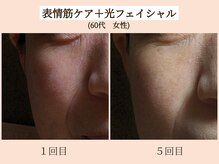 ラーナ(Lana)/リフトアップEMS×光　