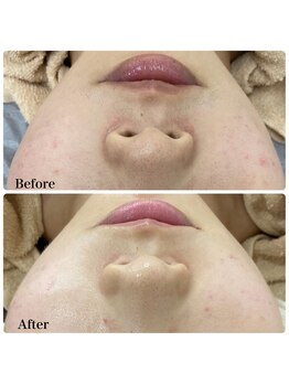 モスト(MOST)/エンビロンでビタミンAを導入