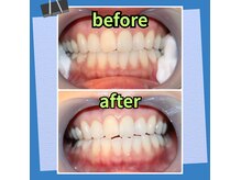 セルフドビューティーケイナックス(SELF d'e BEAUTY K-nacks)の雰囲気（K-nacksのホワイトニングなら満足のbefore→after）
