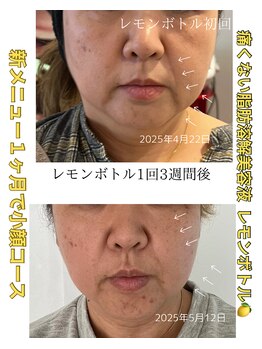 グラシュ(Gracieux)/韓国発脂肪撃退!レモンボトル