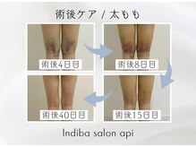 アピ(api)/症例写真【インディバ】