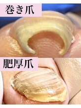 ウォーク(Walk)/巻爪/肥厚爪/変形爪¥6,000(1爪)