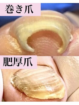 ウォーク(Walk)/巻爪/肥厚爪/変形爪