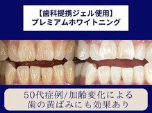 ホワイトニングカフェ 仙台店(WhiteningCafe)/☆プレミアムホワイトニング☆