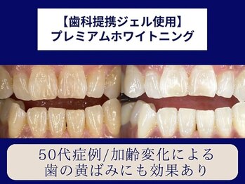 ホワイトニングカフェ 仙台店(WhiteningCafe)/☆プレミアムホワイトニング☆