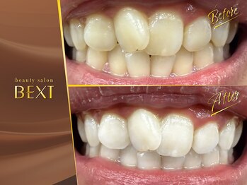 ベクスト(BEXT)/セルフホワイトニング