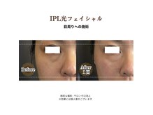 サロンゼロ(salon zero)の雰囲気（IPL光フェイシャルで美肌に欠かせない「線維芽細胞」を活性化♪）