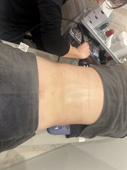 ビジリンヌ/ラジオ波フェイシャル