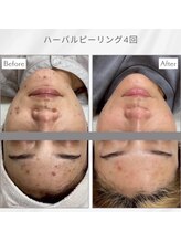 エアリアル 南行橋店/人気のハーブピーリング