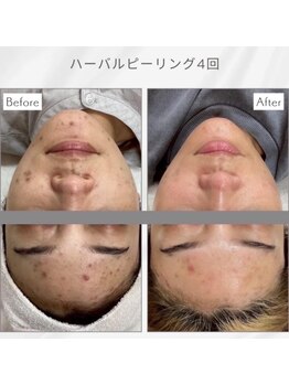 エアリアル 南行橋店/人気のハーブピーリング