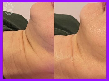 ヴィオール 名古屋栄店(VIOR)/光フェイシャル Vショット!