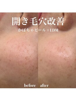 イロハ(IROHA)/開き毛穴改善!