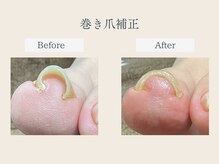 ルポ 伊勢の雰囲気（透明で目立ちにくい補正器具となっております。）