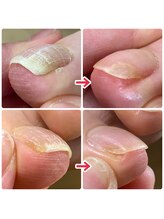 ユキネイル(YUKINAIL)/巻いた爪、ホッとできる足に！！