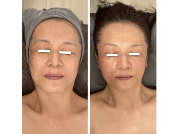 ジーニー(Genie)/ダウンタイムのない期待肌！