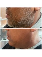 リモレア(RemoLe'a)/即ツルWAX＋光の[MIX脱毛]