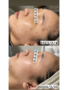 ルアラナ(Lualana)/プラズマエステ