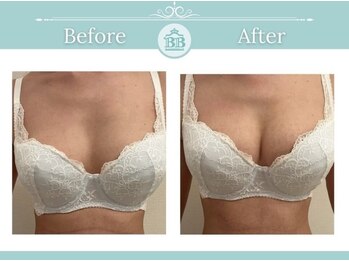 美人バスト 静岡店/バストアップ症例