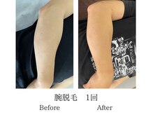 メンズミーシェ(Men's Meshie)/ひじ下脱毛