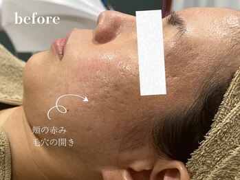 ドクターエイチ 四ツ橋堀江店(Doctor.H)/ハイドロ＋ハーブ＋無針水光注入