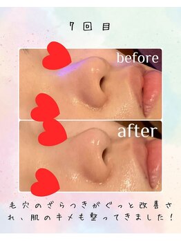 リリアン(lirien)/毛穴/毛穴ケア/毛穴洗浄/駒込