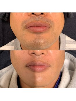 メンズスタジオ リボーン(REBORN)の写真/＜松山/メンズ脱毛＞ヒゲ脱毛で清潔感UP｜第一印象を変える専門店