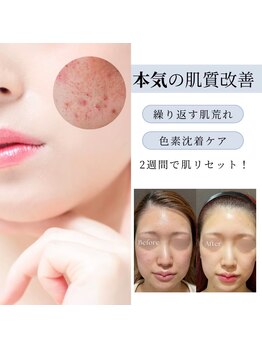 ビボーラ(BEBEAURA)の写真/肌悩みがある方は肌質改善コースを！もっとお肌を綺麗にしていきたい方は肌管理メニューを☆(艶肌/透明感)