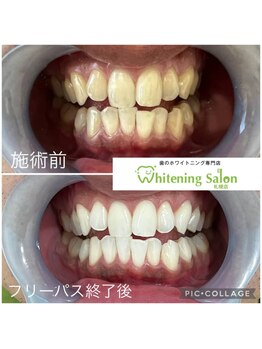 ホワイトニングサロン 札幌店/【ホワイトニング】#札幌#大通り