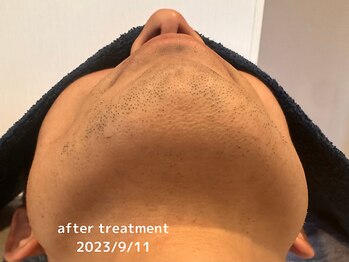 オアシスラグーン(OASIS LAGOON)/メンズ脱毛(症例7:after)