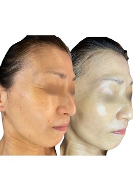 ラリマ(La-lima)/50代女性/肌質改善