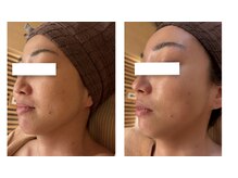 ザ ワン(THE ONE)/ヴェルナハーブピーリング