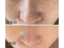 毛穴研究所の雰囲気（丁寧で優しい独自の角栓除去法で毛穴奥の詰まりまでスッキリ爽快）