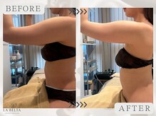 エステティックサロン ラ ベルタ(Esthetic Salon La Belta)/レモンボトル+セルライトゼロ3回