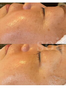 ソイル(Soil)/Wiqo 水光ピーリング