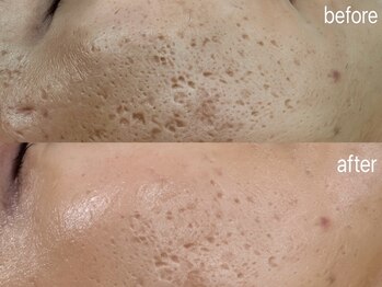 スキニティ(Skinity)の写真/【美肌・肌育・毛穴ケア・リフトならハーブピーリング◎】大注目の痛みほぼ無し、剥けないREVI!