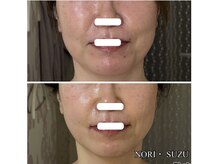 ノリスズ(NORI SUZU)/骨格小顔術×レッドショット3cc